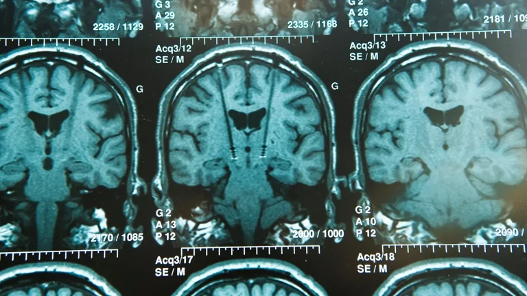 THS und AMPS Zusammenarbeit für die Behandlung von Parkinson