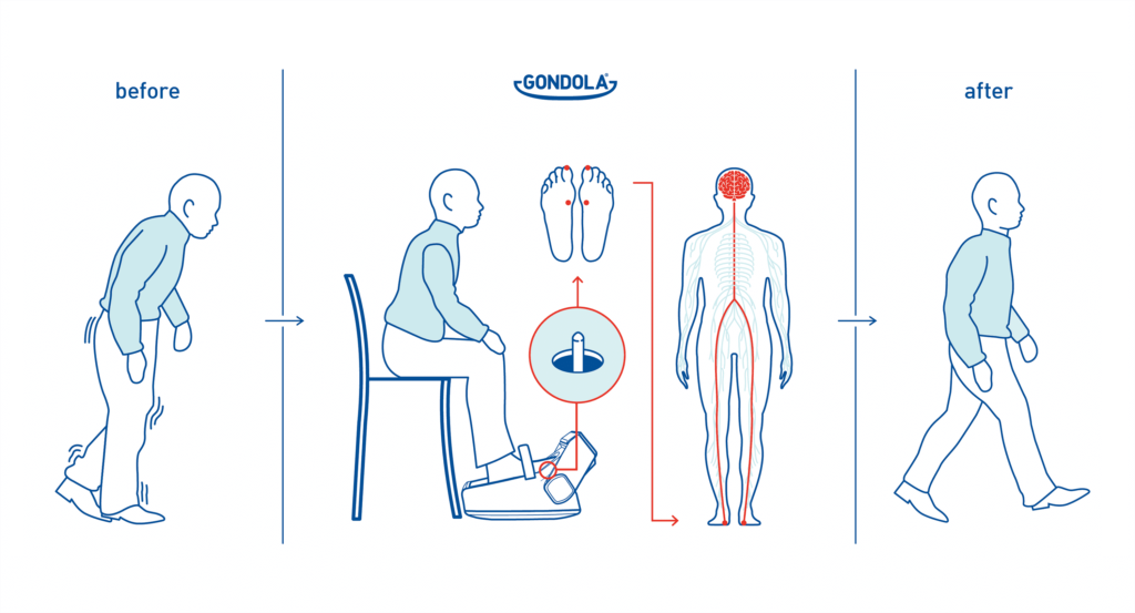 How Gondola AMPS benefits on brain improving walking impairments