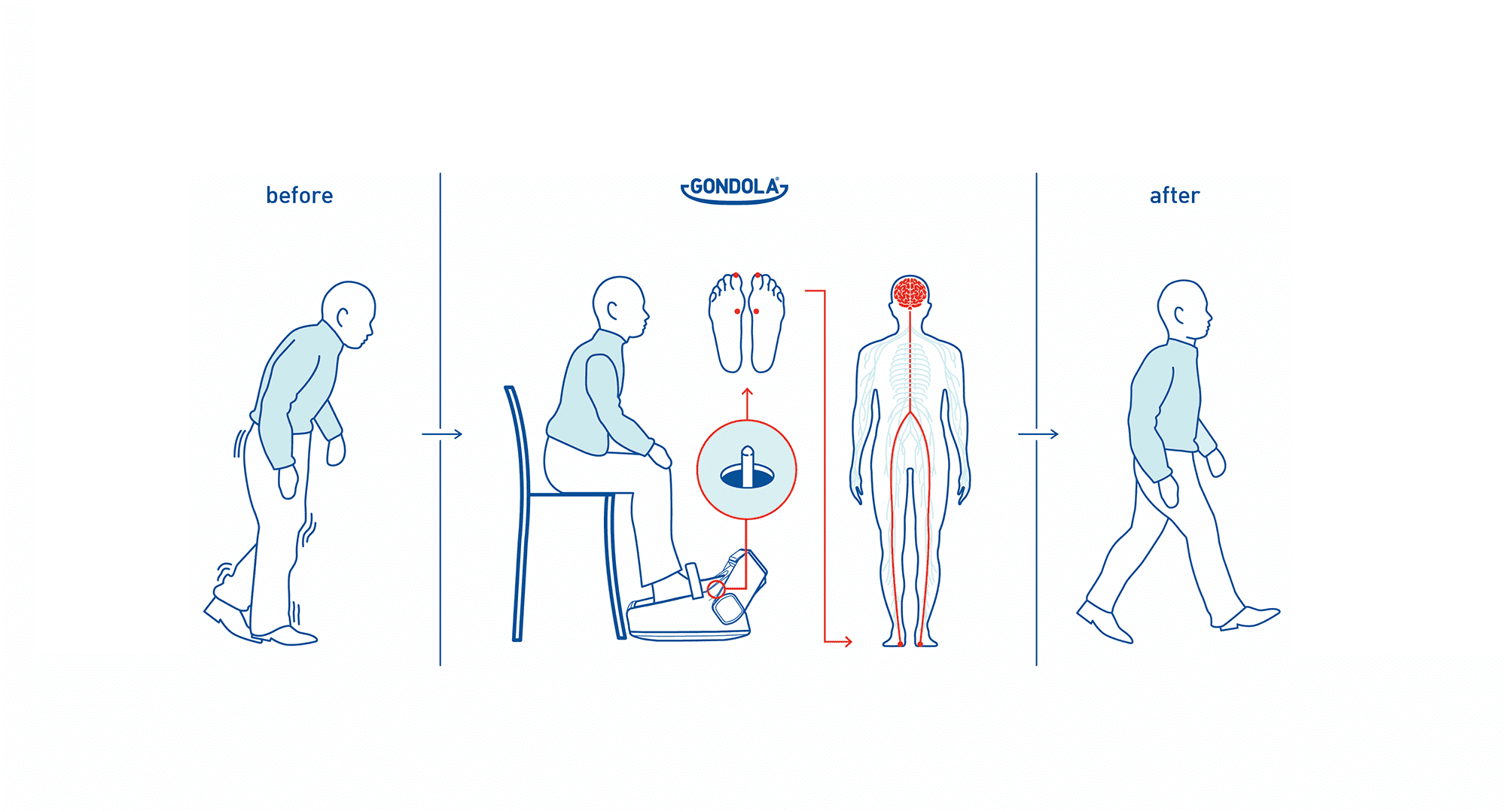 Before and After Gondola AMPS effects on walking and balance